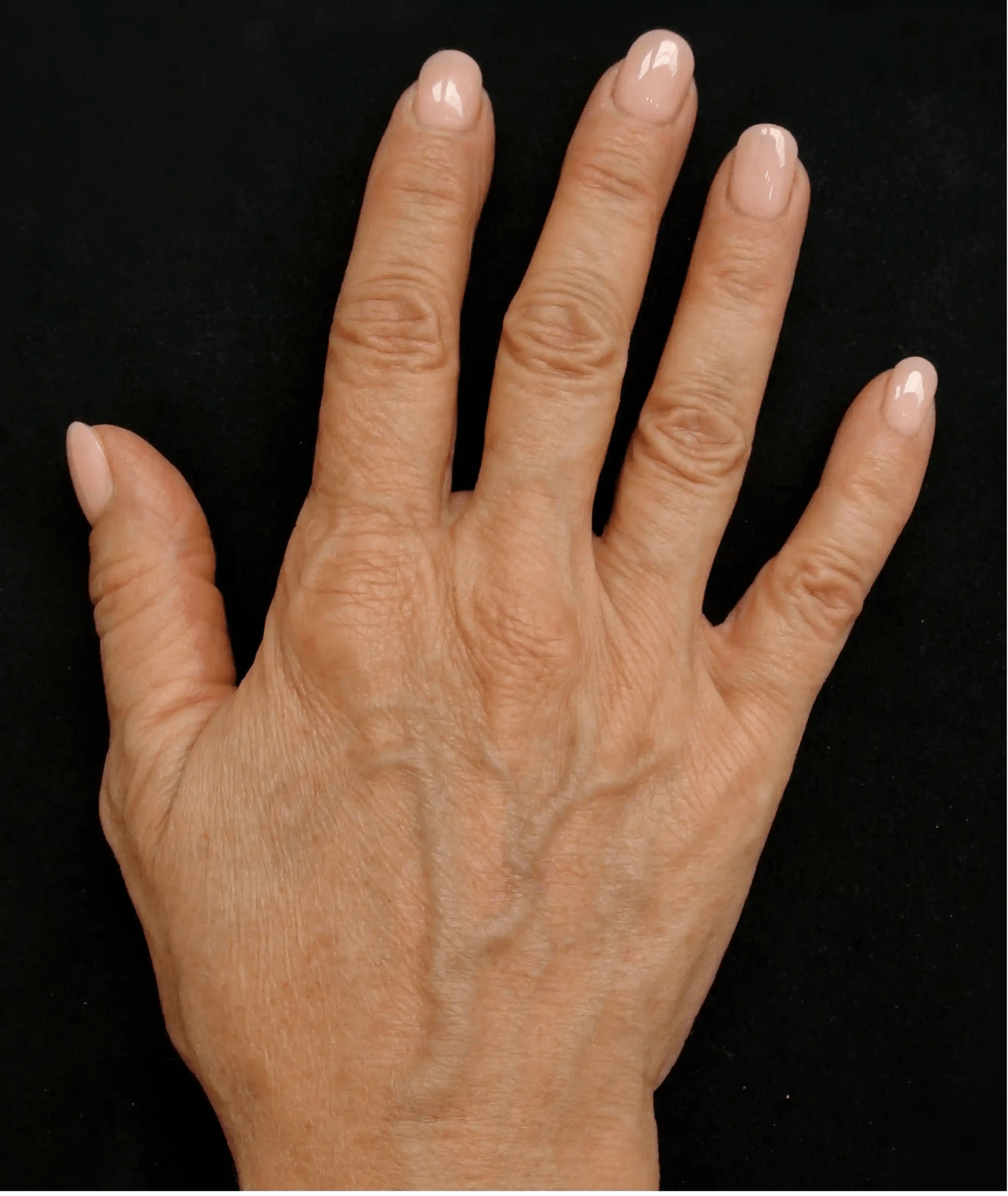 Profhilo hand after
